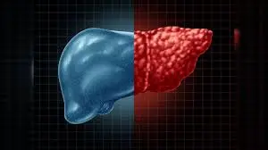 Fatty Liver मतलब गंभीर बीमारियों का जोखिम, जानें आयुर्वेदिक उपाय